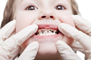 寶寶齲齒常有哪些問題？齲齒問題需注意