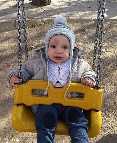 胎記長在哪里有福氣？胎記的本質(zhì)是色素沉著