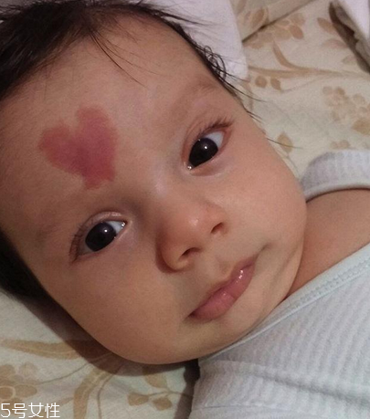 胎記長在哪里有福氣？胎記的本質(zhì)是色素沉著