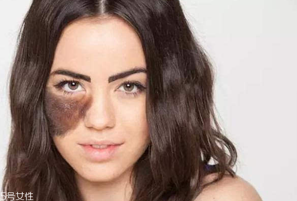 胎記長在哪里有福氣？胎記的本質(zhì)是色素沉著