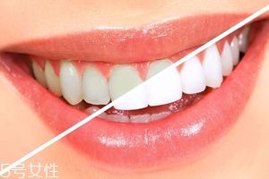 牙齒發(fā)黃是天生的嗎？只是你刷牙偷懶了