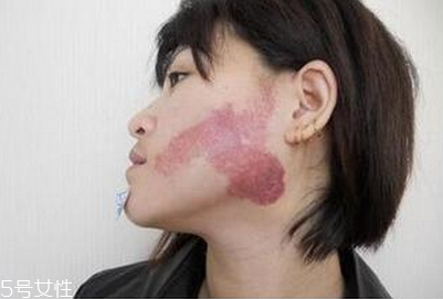 胎記怎么去除？胎記有遺傳的可能