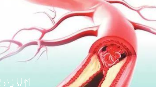 血管堵塞怎么自查？腿腳告訴你答案