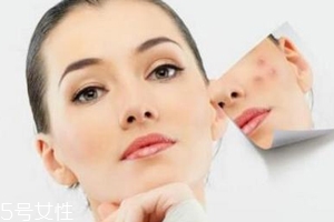 痘印多久能自行消失？多數(shù)人一年內消失