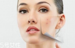 痘印多久能自行消失？多數(shù)人一年內消失