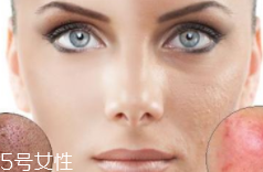 痘印多久能自行消失？多數(shù)人一年內消失