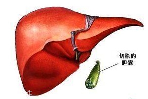 膽囊為什么容易長結(jié)石？與個體因素密切相關(guān)