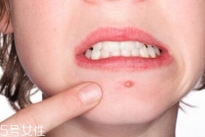 肌膚需要排毒嗎？長痘并不代表排毒