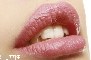 冬天爛嘴角什么原因？有可能營(yíng)養(yǎng)不良