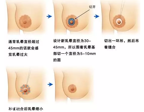 乳暈縮小術(shù)怎么做？乳暈縮小術(shù)知識全解