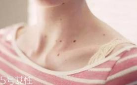 色素痣是腫瘤嗎？良性腫瘤不必?fù)?dān)心