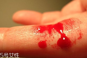 血友病的主要表現(xiàn)有哪些？出血是最明顯的特征