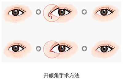 開(kāi)眼角疤痕多久消失？開(kāi)眼角的適宜人群
