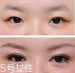 開(kāi)眼角疤痕多久消失？開(kāi)眼角的適宜人群