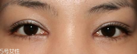 怎么縮短開(kāi)眼角疤痕消失時(shí)間？雙眼皮開(kāi)眼角恢復(fù)過(guò)程