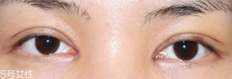怎么縮短開(kāi)眼角疤痕消失時(shí)間？雙眼皮開(kāi)眼角恢復(fù)過(guò)程