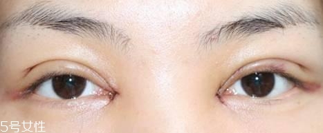 怎么縮短開(kāi)眼角疤痕消失時(shí)間？雙眼皮開(kāi)眼角恢復(fù)過(guò)程