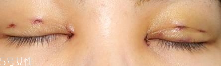 怎么縮短開(kāi)眼角疤痕消失時(shí)間？雙眼皮開(kāi)眼角恢復(fù)過(guò)程