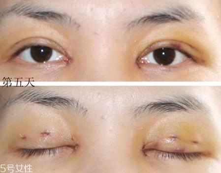 怎么縮短開(kāi)眼角疤痕消失時(shí)間？雙眼皮開(kāi)眼角恢復(fù)過(guò)程