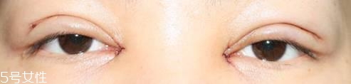 怎么縮短開(kāi)眼角疤痕消失時(shí)間？雙眼皮開(kāi)眼角恢復(fù)過(guò)程