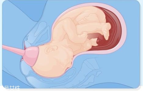 怎樣判斷自己能不能順產(chǎn) 判斷的3個依據(jù)