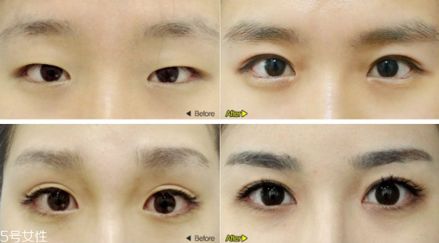 切開雙眼皮效果好嗎？韓式雙眼皮和歐式雙眼皮區(qū)別