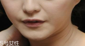 頸紋是怎么產(chǎn)生的？比面部肌膚更加脆弱