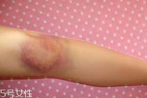 身體淤青怎么來的？不是磕碰那么簡單