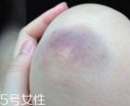 身體淤青怎么來的？不是磕碰那么簡單