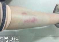 身體淤青怎么來的？不是磕碰那么簡單