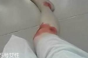 摔傷了涂什么藥好的快？做好消毒才能愈合快