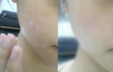 去角質(zhì)凝露哪些人不能用？痘痘肌別用