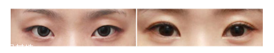 下眼瞼整形手術(shù)會留疤嗎？一般無明顯疤痕