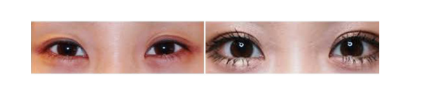 下眼瞼整形手術(shù)會留疤嗎？一般無明顯疤痕