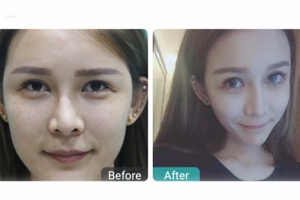 下瞼整形多久能恢復自然？半年時間