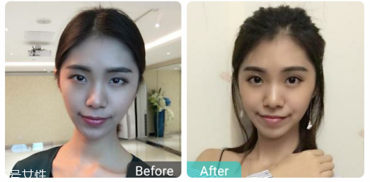 下瞼整形多久能恢復自然？半年時間