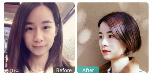 下瞼整形多久能恢復自然？半年時間