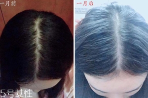 柳屋生發(fā)水有用嗎？一個(gè)月后長出新發(fā)