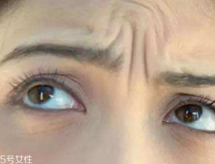 川字紋可以手術(shù)去除嗎？選擇手術(shù)需謹(jǐn)慎