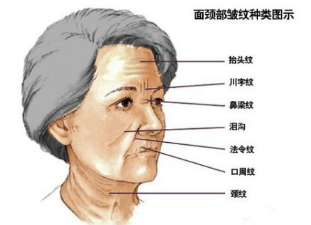 川字紋可以打玻尿酸嗎？不是最佳選擇