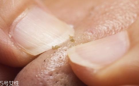 去黑頭用什么最有效？徒手?jǐn)D黑頭容易感染