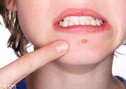 skinb5抗痘護膚片有效果嗎？