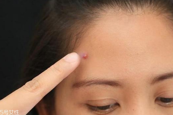 痘印顏色加深是怎么回事？補水還不夠