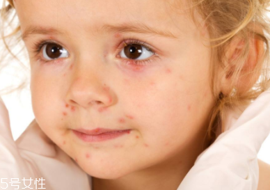 痘印顏色加深是怎么回事？補水還不夠