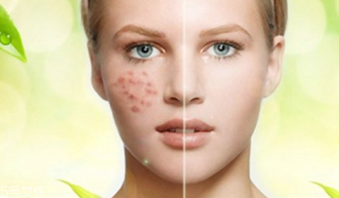 痘印顏色加深是怎么回事？補水還不夠