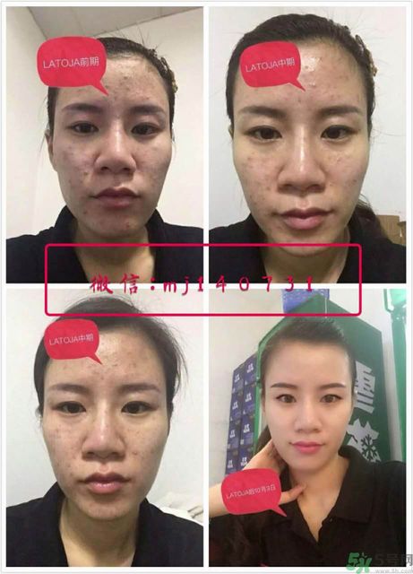 涵曦排毒針效果怎么樣？涵曦新品排毒針安全有副作用嗎？