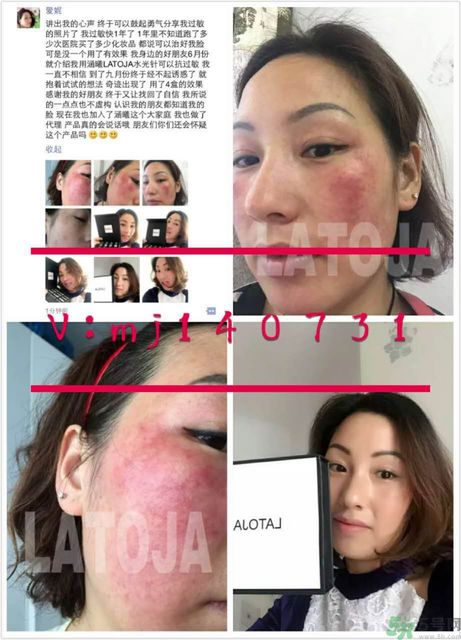 涵曦排毒針效果怎么樣？涵曦新品排毒針安全有副作用嗎？