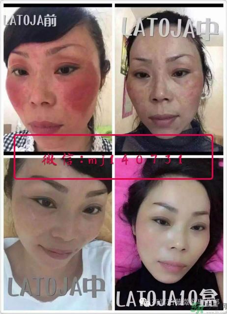 涵曦排毒針效果怎么樣？涵曦新品排毒針安全有副作用嗎？