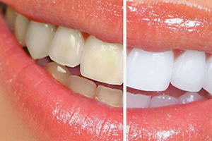 牙貼可以每天用嗎？牙貼多久用一次