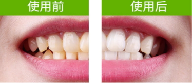 牙貼怎么分上下牙貼？牙貼怎么分正反